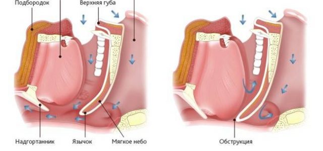 5 причин храпа, когда он становится проблемой