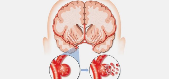 Аневризма сосудов головного мозга