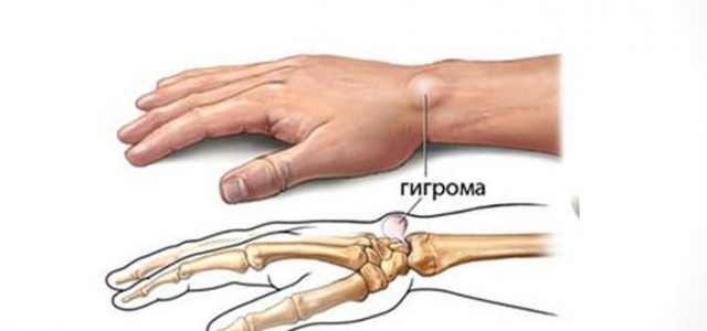 Шишка на запястье