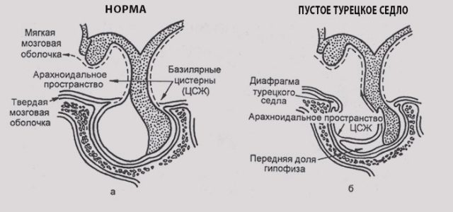 Турецкое седло в головном мозге