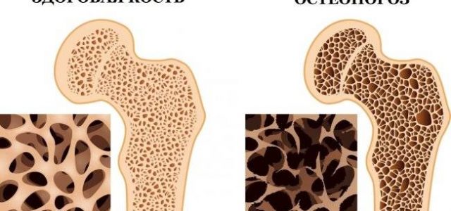 Как работают лекарства от остеопороза и какие лучше