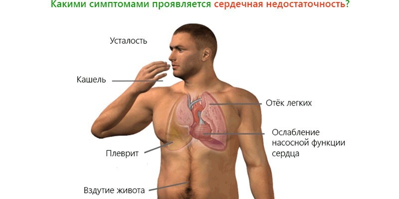 Признаки сердечной недостаточности. Симптомы СН. Сердечная недостаточность у мужчин. Симптомы ХСН У мужчин. Симптомы сердечной недостаточности у мужчин.