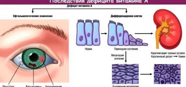 Дефицит витамина А, причины и симптомы, лечение