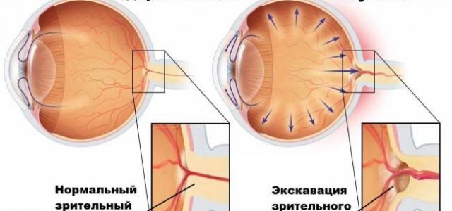 Как глаукома влияет на ваше зрение