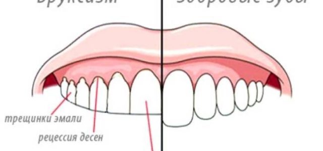 Что такое бруксизм