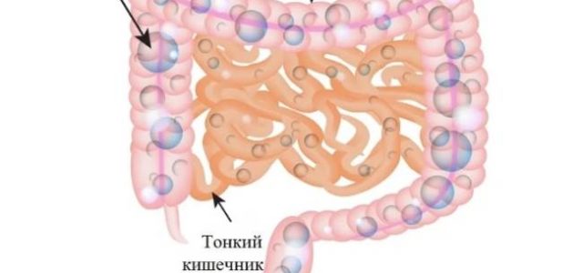 Пневматизация кишечника что это такое. Пневматоз тонкого кишечника. Колит пневматоз кишечника. Фрагментарный пневматоз тонкой кишки. Урчание в тонкой кишке.