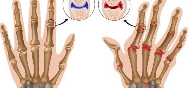 7 хронических состояний, которые можно лечить с помощью иглоукалывания