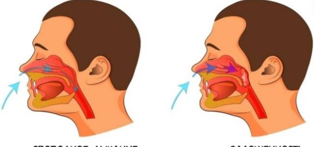 Как избавиться от заложенности носа в домашних усл