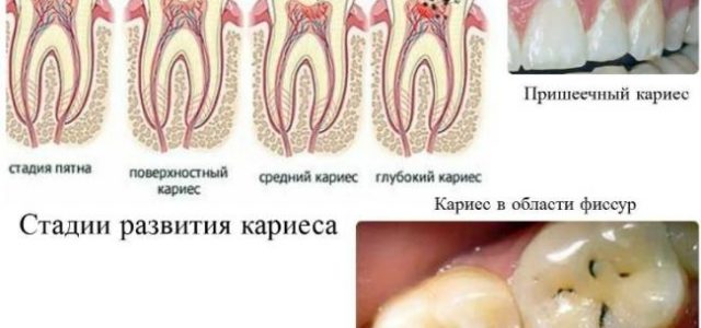 Мифы и правда о лечении кариеса в домашних условиях