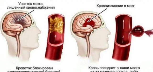 Разница причин инсульта у мужчин и женщин