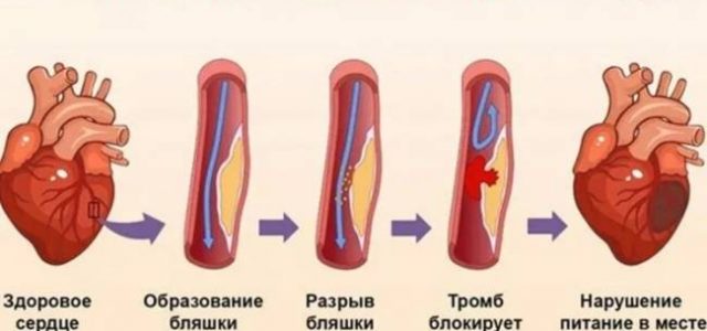 В чем разница между инфарктом миокарда и остановкой сердца