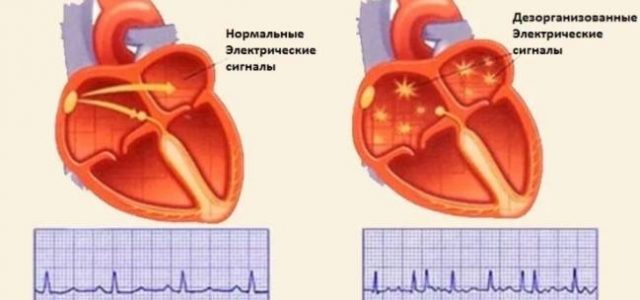 5 фактов о мерцательной аритмии