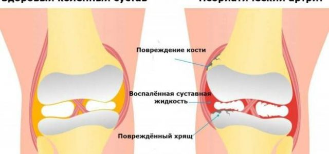 Как предотвратить обострение псориатического артрита