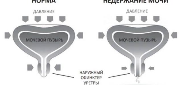 Недержание мочи у женщин