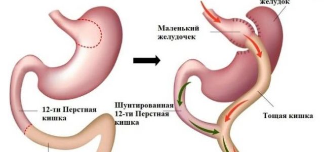 Преимущества и недостатки операции по шунтированию желудка