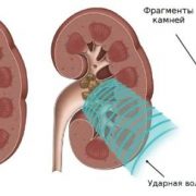 Могут ли камни в почках уйти сами по себе