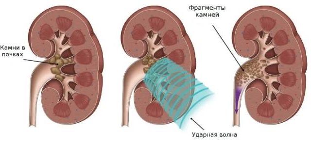 Могут ли камни в почках уйти сами по себе