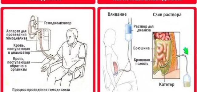 Различные виды диализа и их преимущества и недостатки