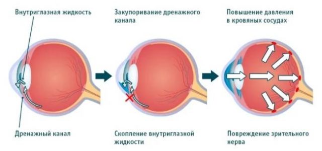 Симптомы глаукомы, которые необходимо знать