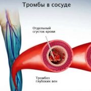 Как и почему образуются тромбы