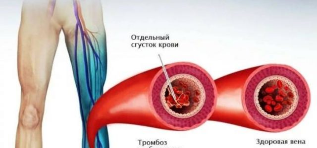 Как и почему образуются тромбы