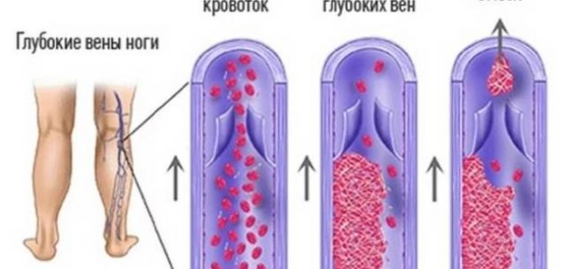 Распознавание симптомов образования тромбов