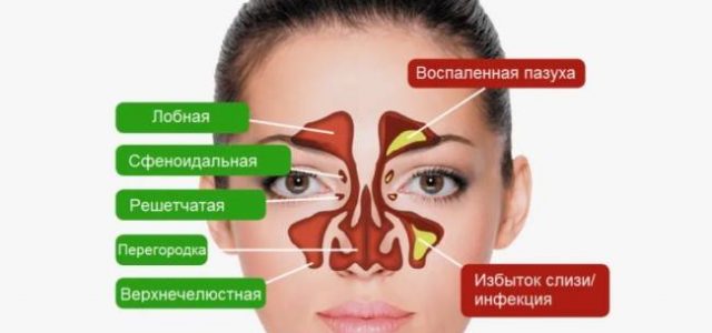 Как отличить насморк от инфекции пазух носа