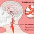 Можно ли предотвратить аневризму головного мозга