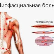 Разница между миофасциальной болью и фибромиалгией