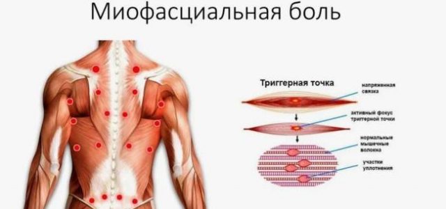 Разница между миофасциальной болью и фибромиалгией