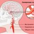 Можно ли вылечить аневризму головного мозга