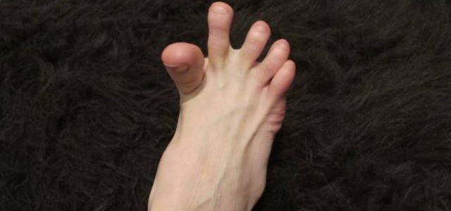 Почему возникают судороги в пальцах ног, как найти облегчение