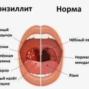 Следует ли использовать антибиотики при ангине