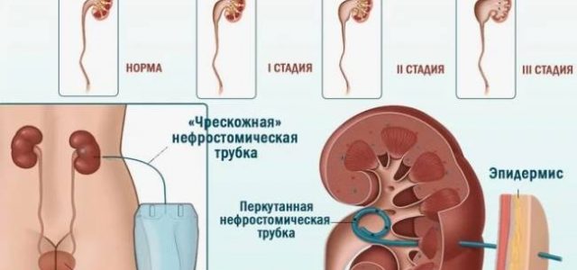 Что такое гидронефроз одной почки