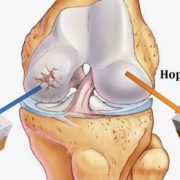 Что такое остеоартрит коленного сустава