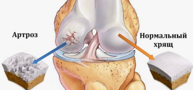 Что такое остеоартрит коленного сустава