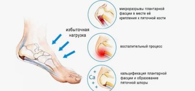 Что такое подошвенный фасциит (боль в пятке)