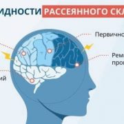 Что значит обострение рассеянного склероза