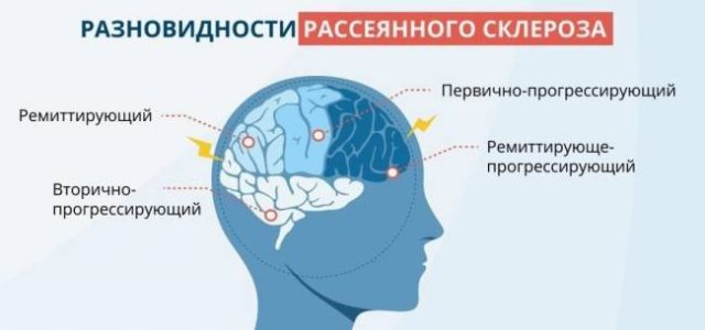 Что значит обострение рассеянного склероза