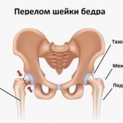 Может ли перелом шейки бедра зажить без операции