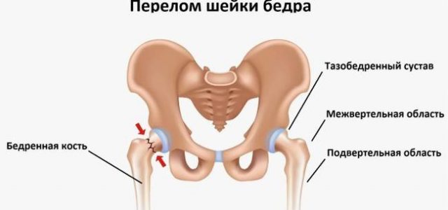 Может ли перелом шейки бедра зажить без операции