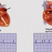 Нерегулярное сердцебиение? Это может быть мерцательная аритмия
