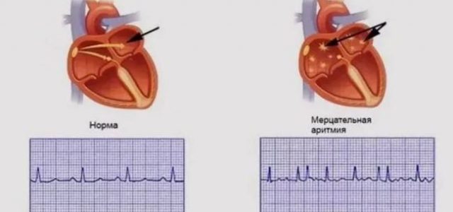 Нерегулярное сердцебиение? Это может быть мерцательная аритмия