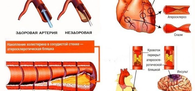 Норма холестерина у женщин в крови после 40 лет