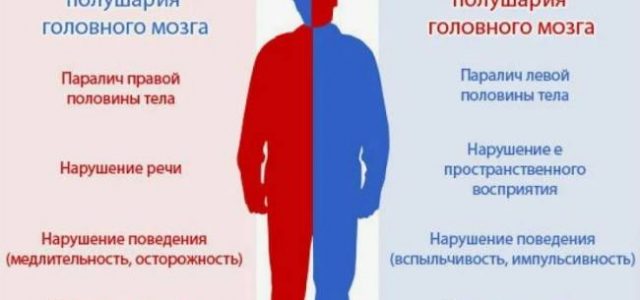 Отличия инсульта правой и левой половины головного мозга