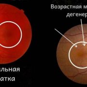 Что такое географическая атрофия, как она влияет на зрение