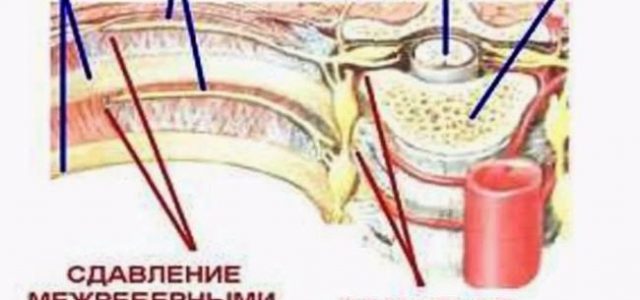 Что такое межреберная невралгия