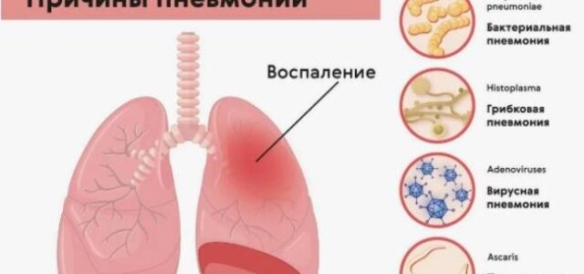 Что такое внебольничная пневмония