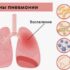 Что такое внебольничная пневмония